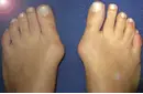 Ayak Baş Parmağı Kemik Çıkıntısı