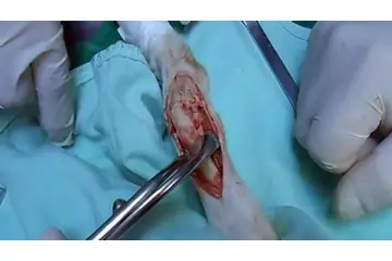 Kemik Ameliyatı Riskleri ve Sonrası