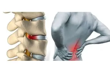 Kuyruk Kemiği Ağrısı Belirtileri ve Tedavisi