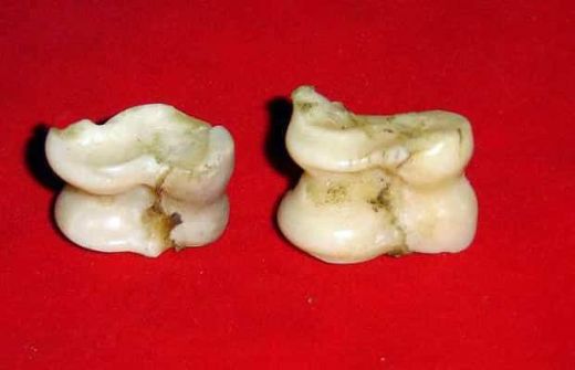 Aşık Kemiği Kırığı Tedavisi