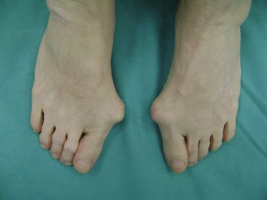 Ayak Baş Parmağında Kemik Çıkıntısı