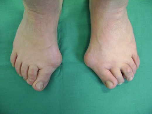 Ayak Kemiği Ameliyatı Riskleri ve Sonrası