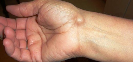 Bilekte Kemik Çıkıntısı Belirtileri ve Tedavisi