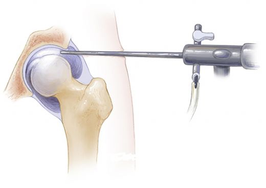 Kalça Kemiği İltihabı Belirtileri ve Tedavisi