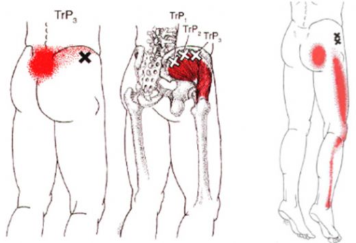 Kalça Kemiği Kayması Belirtileri ve Tedavisi