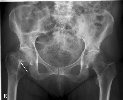 Kalça Kemiği Kırığı Belirtileri ve Tedavisi