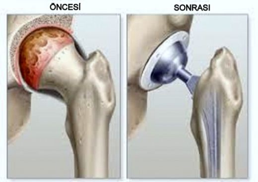 Kalça Kemiği Protezi Ameliyatı