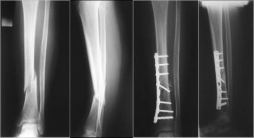 Kaval Kemiği Kırığı Platin