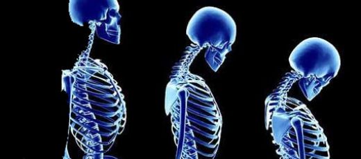 Kemik Erimesi Belirtileri ve Tedavisi