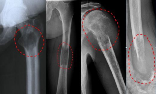 Kemik Tümörü Belirtileri ve Tedavisi