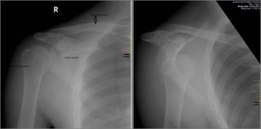 Kürek Kemiği Kırığı Belirtileri ve Tedavisi