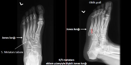 Metatarsal Kemik Kırığı Belirtileri ve Tedavisi